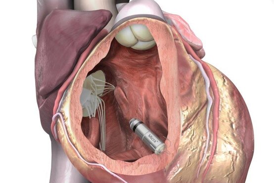Grafische Darstellung eines Herzens mit implantiertem kabellosen Micra™-Herzschrittmacher von Medtronic. 