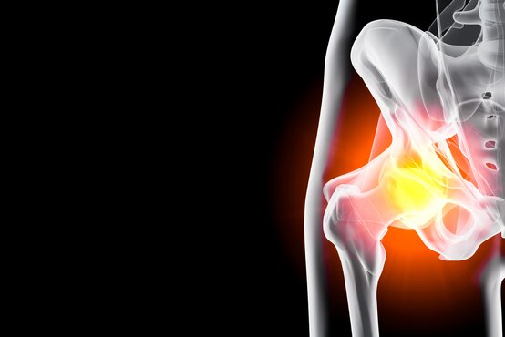 Medizinische Illustration vom Becken mit markierter Hüftfehlstellung, gelb-rot hervorgehobenes schmerzhaftes Hüftgelenk