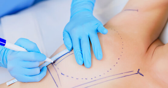 Hände mit sterilen Handschuhen zeichnen präoperative Markierungen mit Stift und Maßband auf die Haut einer Patientin