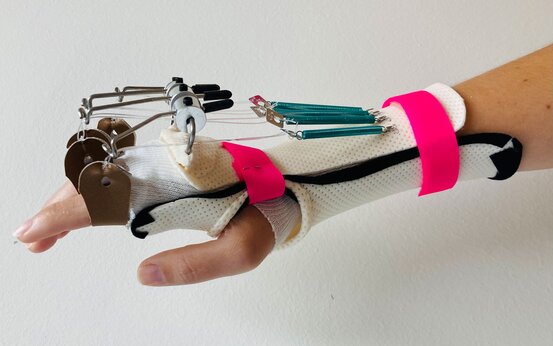 Hand mit individuell angepasster dynamischer Fingerschiene aus Kunststoff, pinke Klettverschlüsse, Metallfedern und Drahtzüge zur Fingerbewegung