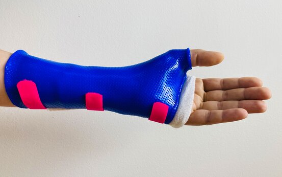 Ausgestreckte Arm mit blauer, perforierter Unterarm-Schiene aus Kunststoff und drei pinken Befestigungsstreifen