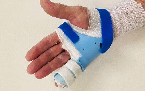 Hand mit weißem Verband und blauer Schiene, kleiner Finger bandagiert