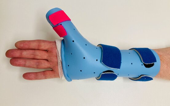 Hand in blauer Orthese mit Belüftungslöchern, Daumen separat mit pinken Riemen stabilisiert, drei blaue Klettverschlüsse am Unterarm