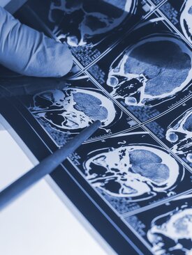 Mehrere MRT-Aufnahmen eines menschlichen Gehirns