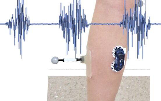 Unterschenkel mit reflektierenden Markern und sEMG-Elektroden, eingeblendete Muskelsignalkurve, klinische Ganganalyse