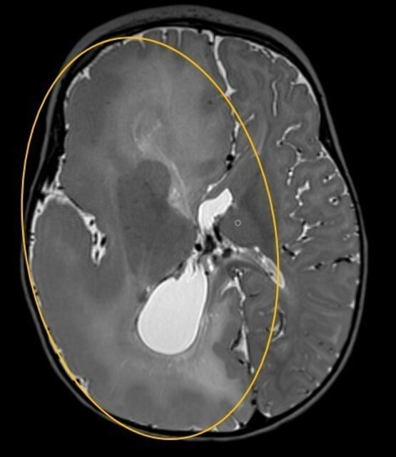 Axiale MRT-Aufnahme des Gehirns mit großem linksseitigem Tumor, gelb umrandet 