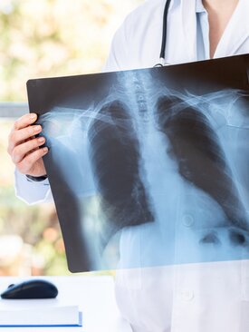Arzt hält Röntgenbild der Lunge