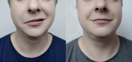 Vorher-Nachher-Vergleich einer männlichen Mundpartie, links schiefer Mundwinkel, rechts verbesserte Symmetrie