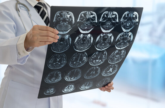 Medizinisches Fachpersonal hält MRT-Bilder mit mehreren Kopf-Schnittbildern