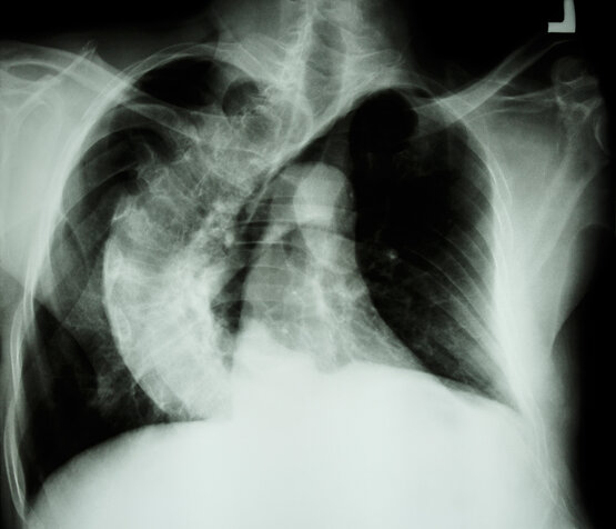 Röntgenbild mit seitlicher Verkrümmung der Wirbelsäule, medizinische Skoliose-Diagnostik in der Klinik