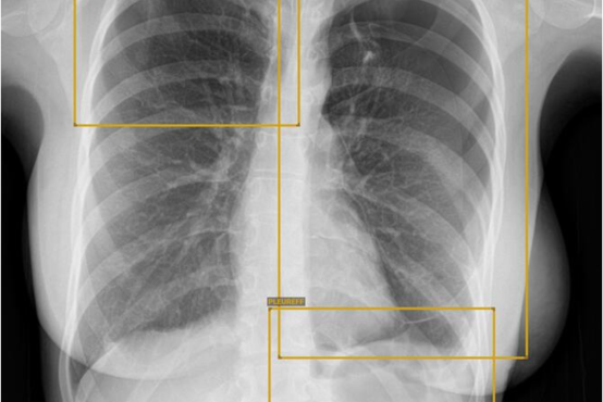 Röntgenbild des Brustkorbs mit gelben Markierungen für Pneumothorax beidseits und Pleuraerguss rechts