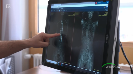 Computerbildschirm im Wirbelsäulenzentrum zeigt zwei Röntgenaufnahmen der Wirbelsäule, Hand deutet auf Implantate