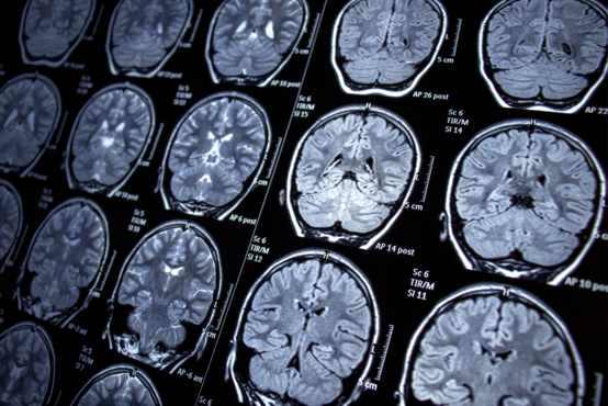 MRT-Aufnahmen des Gehirns.