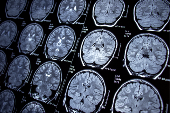 MRT-Aufnahmen des Gehirns.